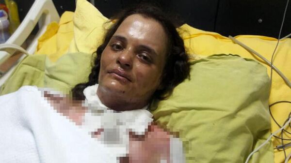 Dezenfektanın patlamasıyla yanan kadın, 75 gündür yoğun bakımda - Sputnik Türkiye